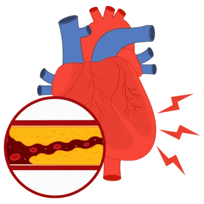 Nutrición en Enfermedades cardiovasculares Nutrición en Enfermedades cardiovasculares